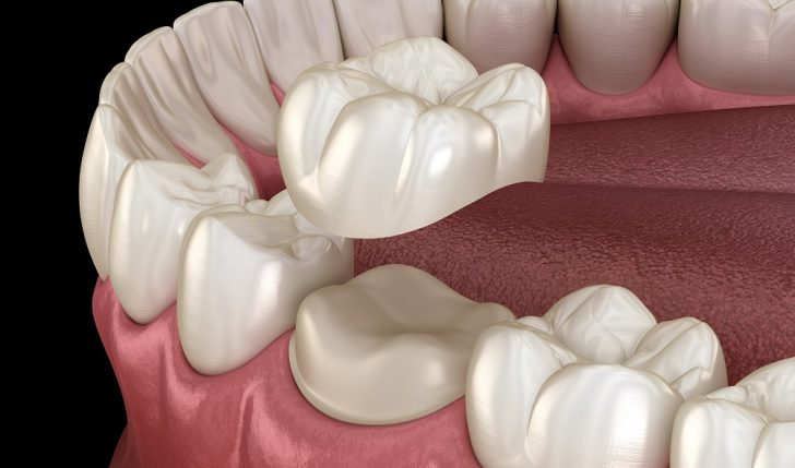 Preparated molar tooth for dental crown placement. Medically accurate 3D illustration