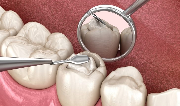 Decayed tooth restoration with composite filling. Medically accurate tooth 3D illustration.